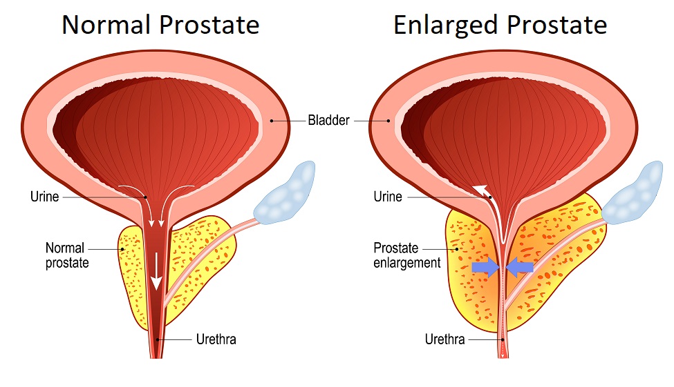 The Best Supplements To Support Prostate Health In 2021 Smarter Reviews